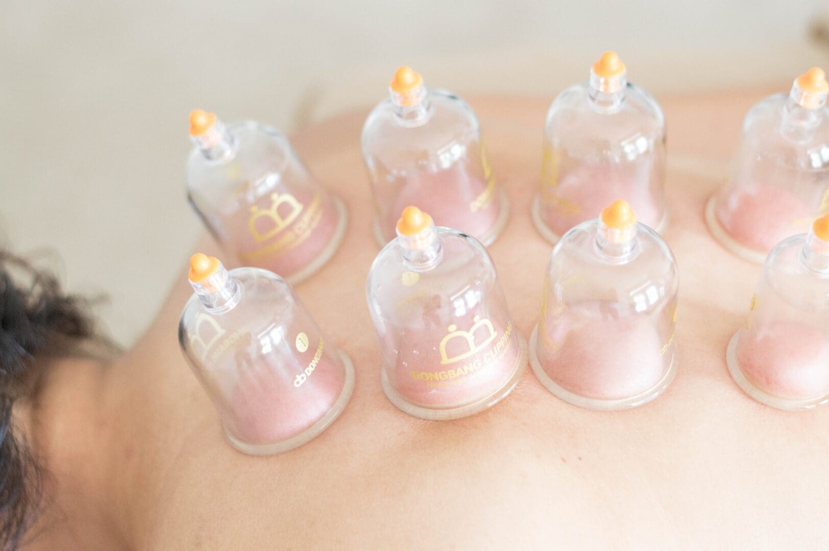 Cupping